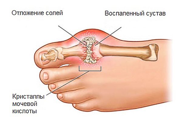 симптомы избытка мочевой кислоты