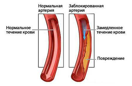 Холестерин в крови