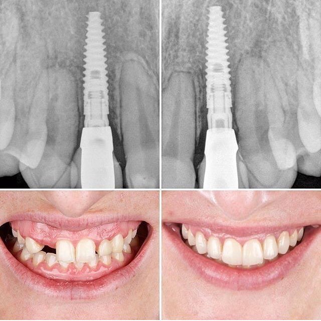 Импланты до и после. Имплантация зубов до и после. Зубные импланты до и после. Зубные импланты результат.