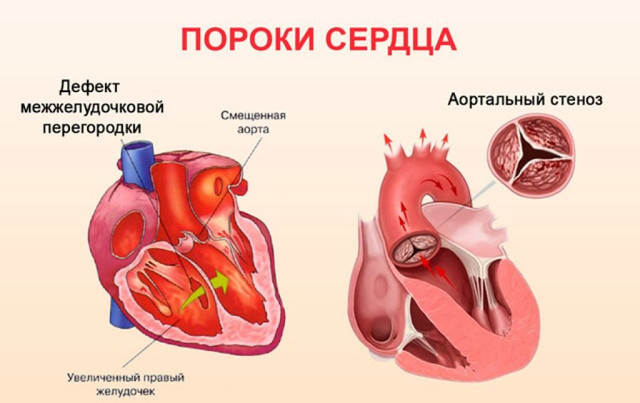 Пороки сердца: что это такое, какие бывают, симптомы, диагностика, лечение сердца, когда, порока, других, Порок, также, органов, изменения, происходит, структурах, приступы, следующим, стеноз, взрослых, порок, риска, систем, Имеются, нарушений, после