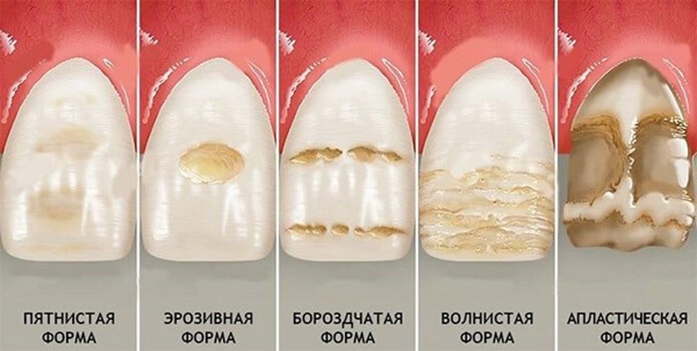 Флюороз — противоположность кариеса (и проверьте, что за воду вы пьёте) эмали, фтора, зубов, флюороз, флюороза, когда, эмаль, будет, потому, только, пятна, дентина, которые, стадии, очень, может, просто, зубах, более, много