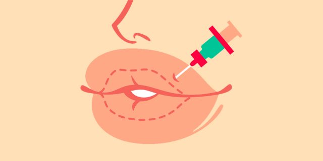 12 фактов, которые надо знать об увеличении губ