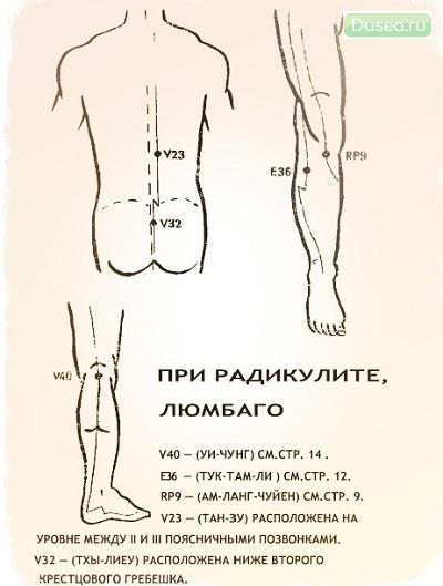 радикулит