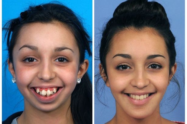 Хирург поправил ей форму челюсти: просто невероятное преображение зубы, красота, пластика, преображение, хирургия, челюсть
