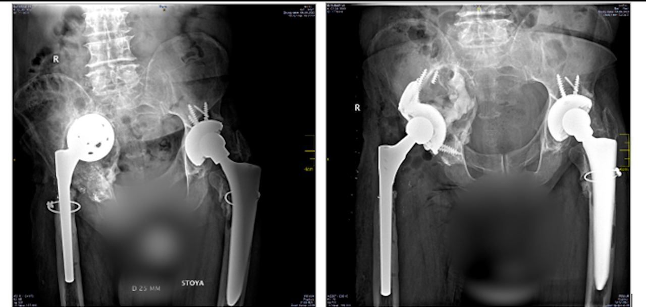 В 2005 году жителю Новокузнецка Виктору Слюсарю провели эндопротезирование обоих тазобедренных суставов, а в 2017 – в ФГБУ «Новосибирский НИИТО им. Я. Л. Цивьяна» Минздрава России выполнена ревизионная операция. Постепенно развивалось асептическое расшатывание бедренного компонента правого тазобедренного сустава, дефект вертлужной впадины справа. Вовремя выполнить ревизию не удалось: Слюсарь перенес инсульт, а затем коронавирус. К 2023 году правая нога стала короче левой на 6 см, усилились боль и хромота. 