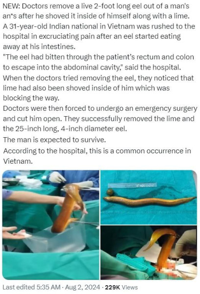 Во Вьетнаме из ануса пациента врачи достали живого 60-сантиметрового угря
