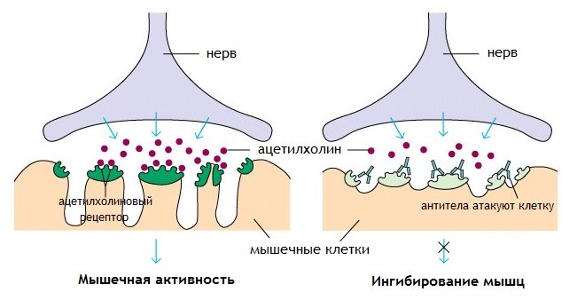 Что такое миастения