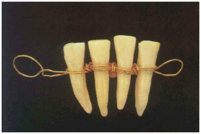 Для протезов использовались также зубы животных. Четвертый век до н.э. - зубы животного на золотой ленте, предназначенные для протезирования интересное, прошлое, стоматологи, ужас, факты
