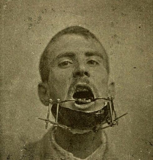 Аппарат для исправления сломанной челюсти, 19 век интересное, прошлое, стоматологи, ужас, факты