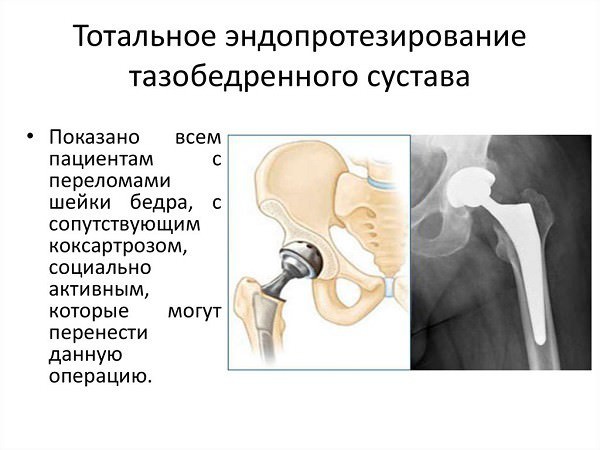 Сколько живут пациенты в пожилом возрасте с переломом шейки бедра бедра, шейки, перелома, кости, пожилом, может, пожилых, возрасте, бедренной, перелом, травмы, после, людей, лечение, области, переломы, переломов, повреждения, костной, пациент