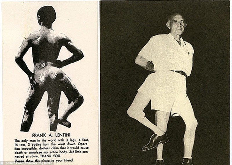 Фрэнк Лентини, который родился с тремя ногами, стал знаменит в США. Его называли не иначе как «Король». Гвоздем его выступления было набивание футбольного мяча третьей ногой деформация, люди