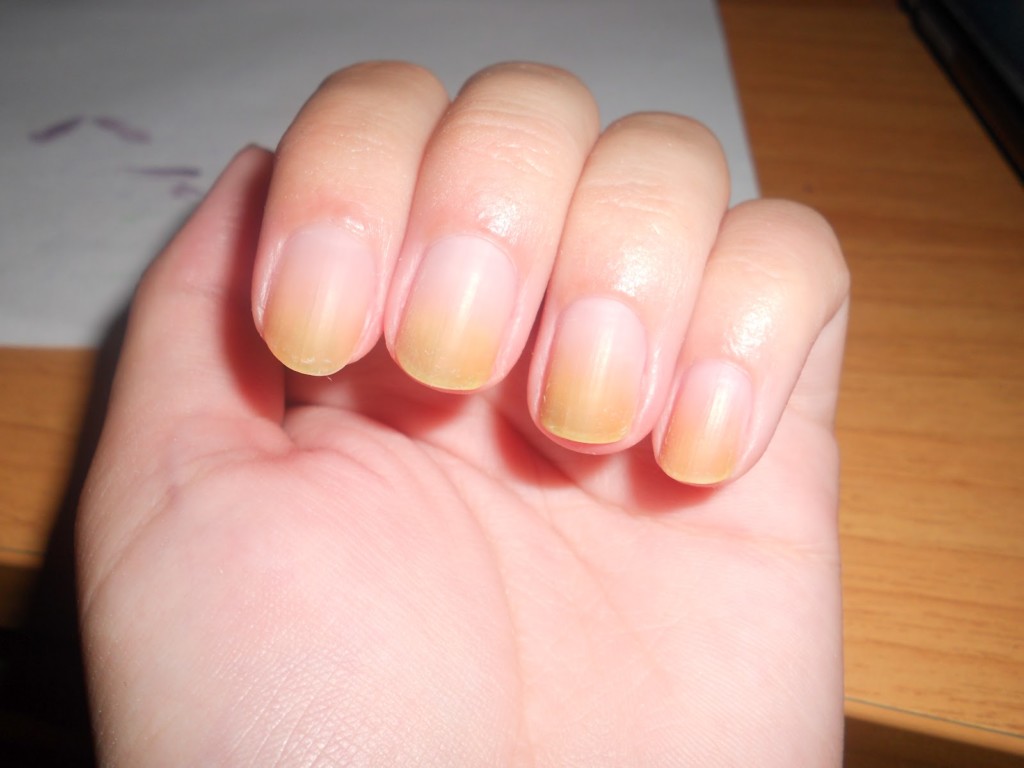 ÐÐ°ÑÑÐ¸Ð½ÐºÐ¸ Ð¿Ð¾ Ð·Ð°Ð¿ÑÐ¾ÑÑ 10 ÑÐ¸Ð¼Ð¿ÑÐ¾Ð¼Ð¾Ð² Ð½Ð¾Ð³ÑÐµÐ¹ Ð¸ ÑÐ¾, ÑÑÐ¾ Ð¾Ð½Ð¸ Ð¾Ð·Ð½Ð°ÑÐ°ÑÑ Ð´Ð»Ñ Ð²Ð°ÑÐµÐ³Ð¾ Ð·Ð´Ð¾ÑÐ¾Ð²ÑÑ