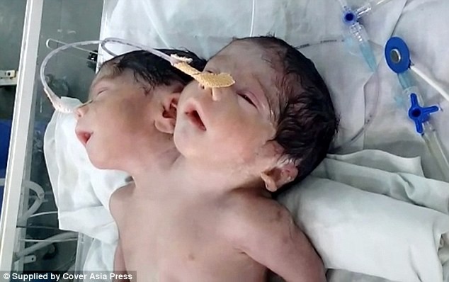 Ребенок в Индии, родившийся с двумя головами, прожил всего 32 часа после родов аномалия, дети, индия, ужас