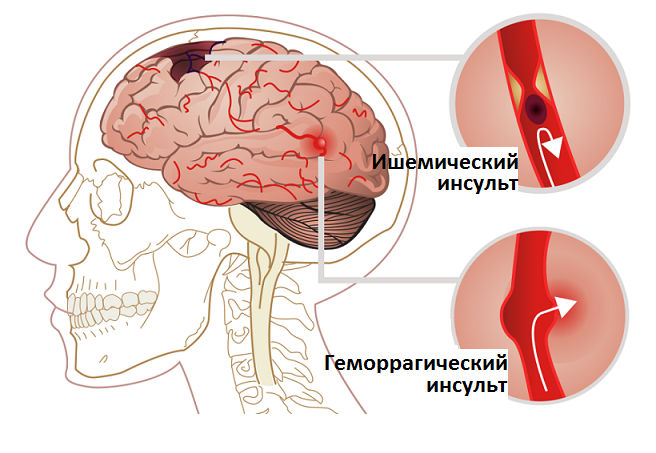 Как распознать инсульт: первые признаки, факторы риска и первая помощь болезни,здоровье,инсульт,первая помощь,признаки,симптомы