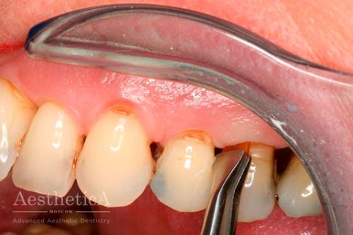 Воспаление пульпы зуба. Краткое описание 02
