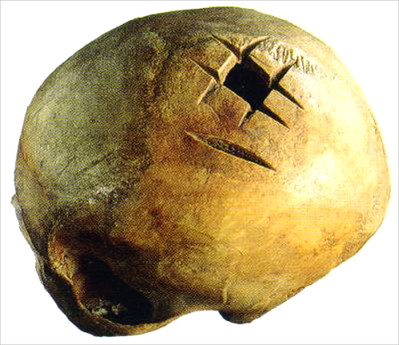Инки – специалисты по трепанации черепа черепа, операции, инков, черепов, трепанации, трепанированных, такого, кости, одной, истории, чтобы, часто, после, черепе, производились, хирургической, трепанацию, применяли, Андах, Перуанских