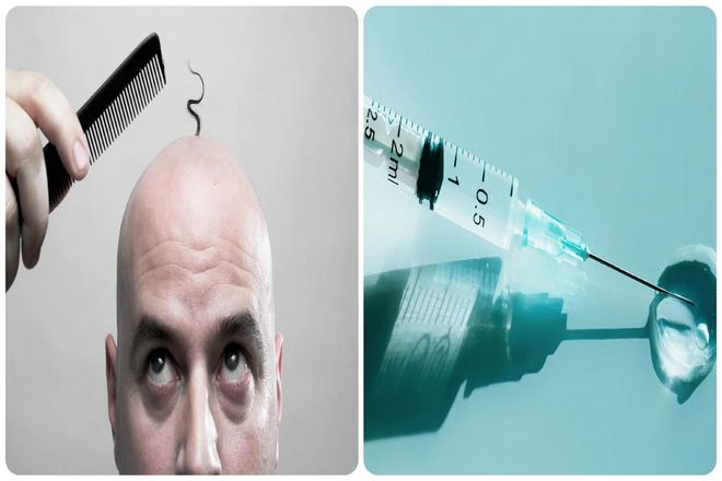 К сожалению, несмотря на многочисленные исследования, лечение облысения оставляет желать лучшего. Правда, мы отошли от времен Гиппократа, когда для лечения выпадения волос рекомендовалось снадобье из опиума, хрена и голубиного помета.