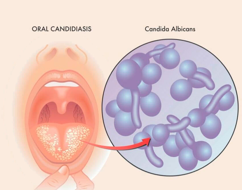 Как избавиться от кандидоза без медикаментов за 3 шага кандидоза, инфекции, Candida, albicans, масла, оболочки, других, овощи, симптомы, вызывает, слизистые, инфекция, организму, тракте, полости, ротовой, дрожжевой, кандиду, причины, Очищение