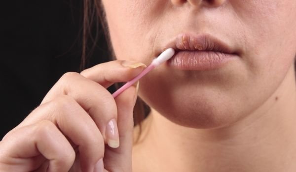 Как бороться с герпесом с помощью геля алоэ вера