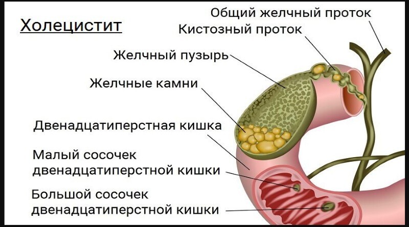 Холецистит – симптомы и лечение у взрослых