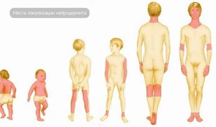 Нейродермит: тут не до шуток, лечением комплексным займитесь и грамотно пролечитесь. Рецепты применяйте, о зуде забывайте!