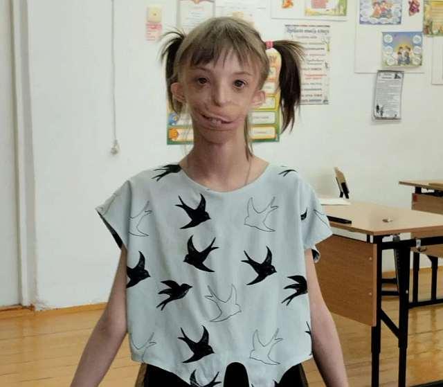 Как живет Дарина Шпенглер из шоу «Мужское / Женское» — девочка с половиной лица Шпенглер, врачи, Дарина, Елене, девочки, девочка, Елена, Девочка, патологии, счастью, ребенка, дочери, могли, будет, родилась, ребенок, Женское», «Мужское, девочке, сразу