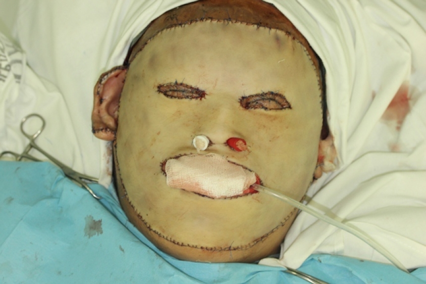 Хирурги из Краснодара впервые в истории пересадили пациенту кожу лица 