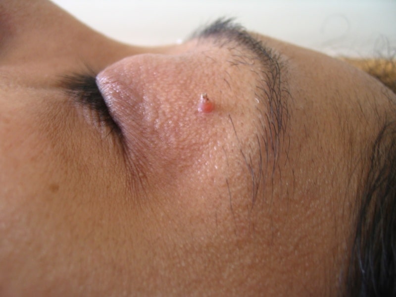 Разновидности и опасность наростов на лице болезни,дерматология,здоровье,кожа