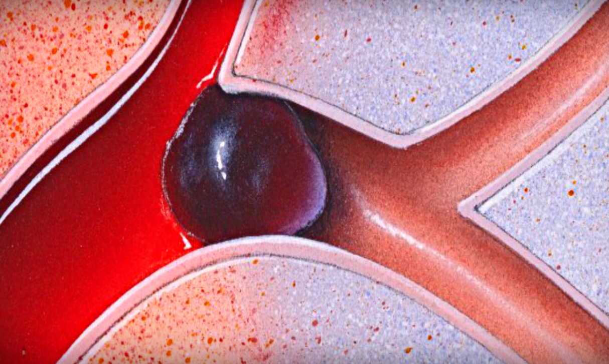 Разжижение крови – это наиглавнейший путь к долголетию!