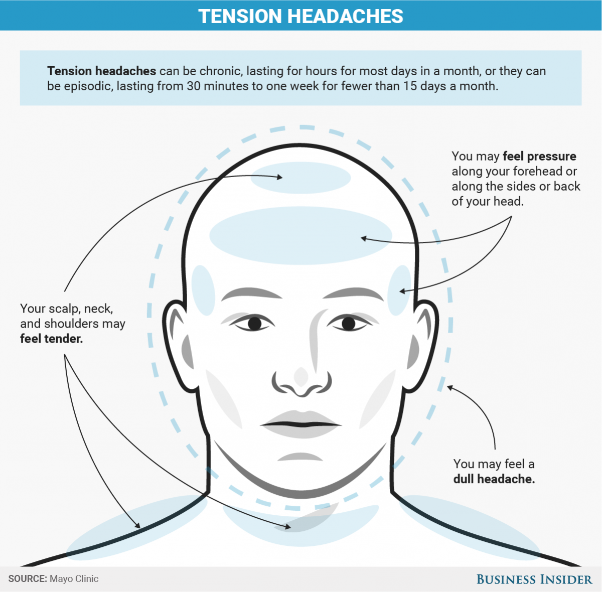 Тензионная головная боль это. Типы головной боли. Головная боль схема. Виды головной боли схема. Тензионная головная боль.