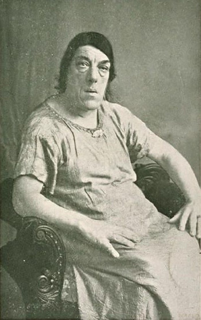 1. Мэри Энн вышла в 1903 году замуж, примерно в это время у нее начала развиваться болезнь под названием "акромегалия" интересно, история, люди-мутанты, мутации, прошлое, фото