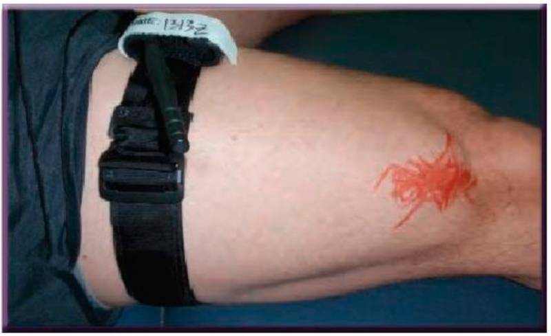 Конверсия турникета: когда и как нужно менять жгут на повязку оружие