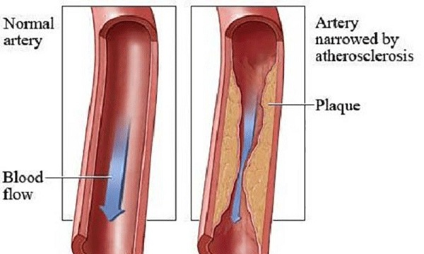 how-to-make-a-fantastic-drink-for-your-clogged-arteries2