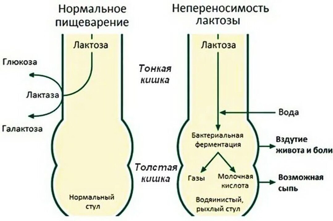 Непереносимость лактозы