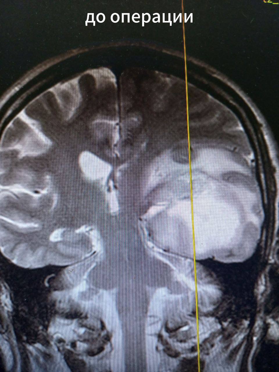Мелитопольские врачи удалили пациенту крупную опухоль головного мозга