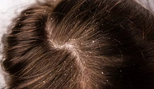 Народные средства в борьбе с себорейным дерматитом