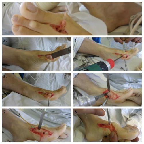 Вальгусная деформация первого пальца стопы. Лечение вальгусного отклонения 1 пальца 02