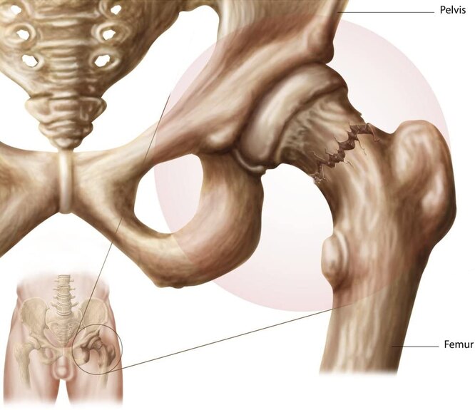 Что такое перелом шейки бедра и как его лечат: 16 вопросов травматологу-ортопеду шейки, бедра, перелома, перелом, пациент, после, операции, лечение, при переломе, пациента, лечения, сустава, только, тазобедренного, эндопротезирование, в случае, больного, шейка, вопрос, в плане