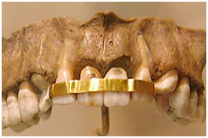 Древние египтяне заменяли зубы донорскими, используя золотую проволоку, чтобы прикрепить зубы донора к собственным зубам интересное, прошлое, стоматологи, ужас, факты
