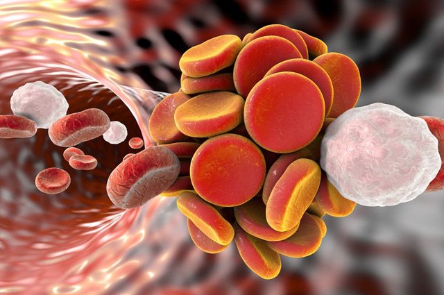 Смертельный тромб. Можно ли избежать беды? болезни,здоровье,сердечно-сосудистые заболевания,тромбоэмболия