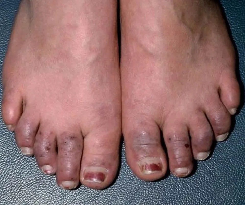 Как ступни отображают состояние здоровья — 8 сигналов о серьезных заболеваниях болезни,диагностика,здоровье,ступни