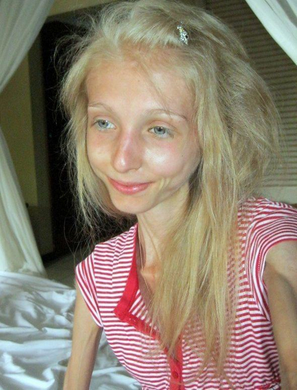 Героиня программы «Пусть говорят» поразила всех чрезмерной худобой. Прошло 8 лет видео,звезда,красота,новости,развлечение,шоу,шоубиz,шоубиз