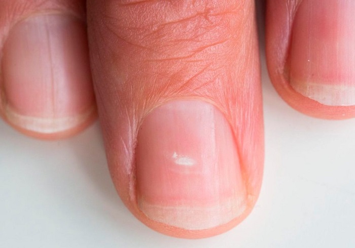 Периодически на ногтях могут появляться белые пятна. / Фото: sn-portal.ru