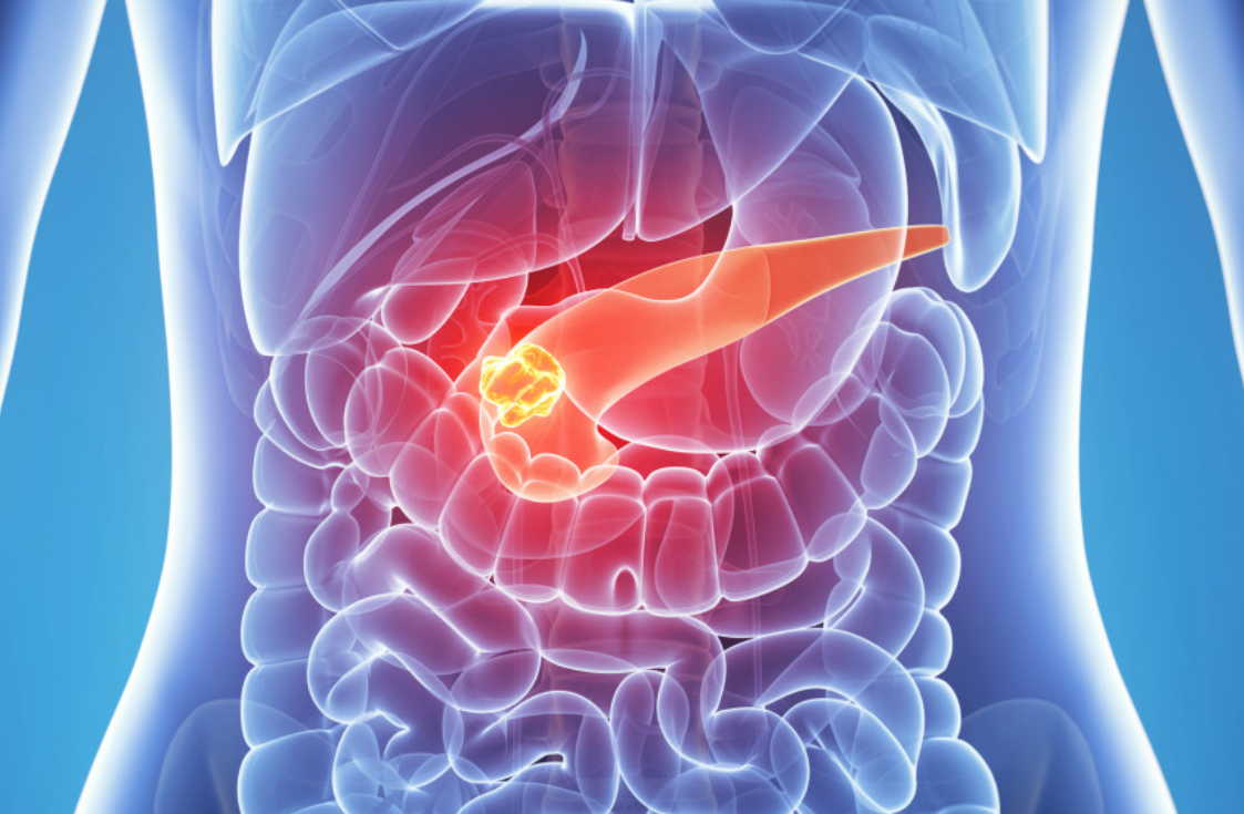 Как остановить панкреатит!