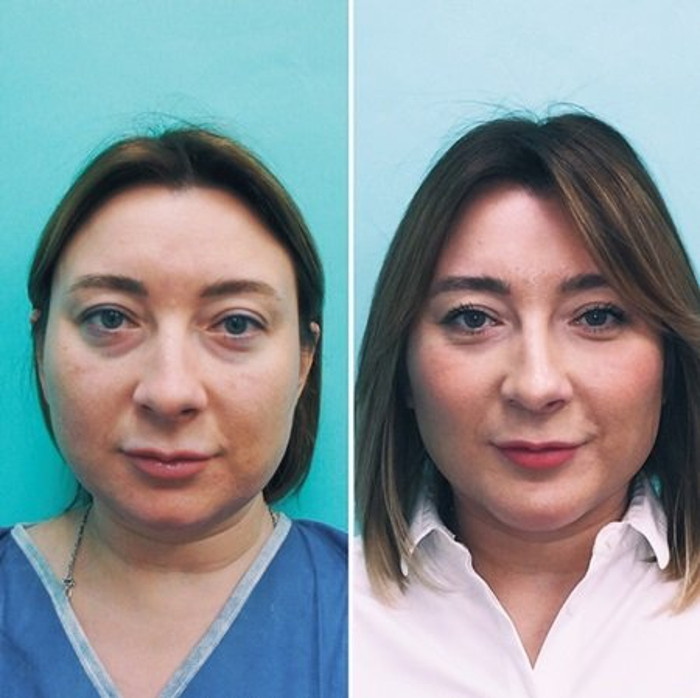 Тонирование лица косметология фото до и после