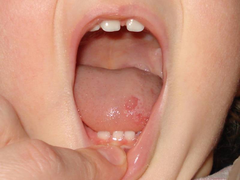 Белые прыщики во рту у ребенка: причины, методы лечения и профилактика