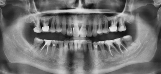 Чистим зубы с кровью: что надо знать зубов, чистить, полости, зубной, чтобы, пародонтита, будет, степени, пародонтолога, часть, налёта, когда, зубного, десны, может, пародонтит, более, который, пациент, процесс