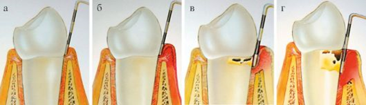 Чистим зубы с кровью: что надо знать зубов, чистить, полости, зубной, чтобы, пародонтита, будет, степени, пародонтолога, часть, налёта, когда, зубного, десны, может, пародонтит, более, который, пациент, процесс