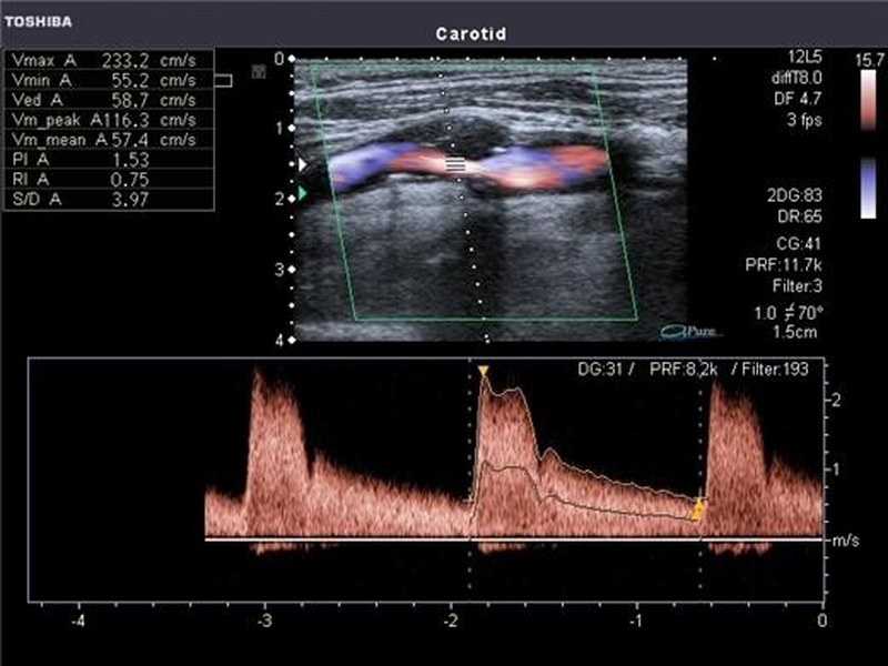 Сканирование позвоночных артерий. Ультразвуковое дуплексное и допплеровское исследование сосудов;. Наружная Сонная артерия на УЗИ. Дуплексное сканирование сосудов сонных артерий норма.