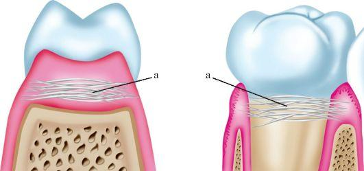 Чистим зубы с кровью: что надо знать зубов, чистить, полости, зубной, чтобы, пародонтита, будет, степени, пародонтолога, часть, налёта, когда, зубного, десны, может, пародонтит, более, который, пациент, процесс